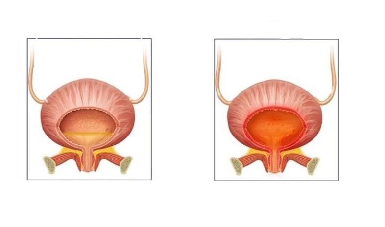 Normāli un pacienti ar urīnceļu cistītu