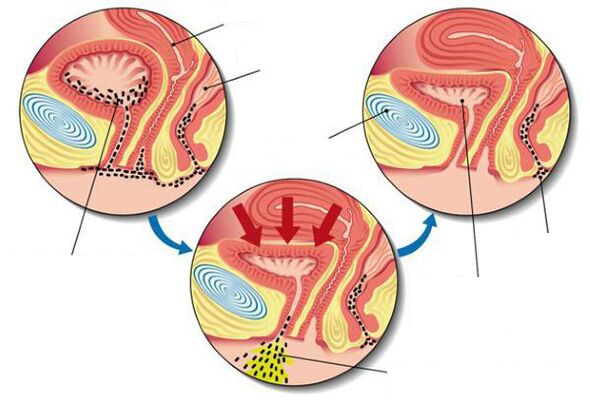 baktērijas urīnpūslī ar cistītu